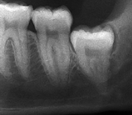 File:Vertical impaction wisdom tooth infection.png