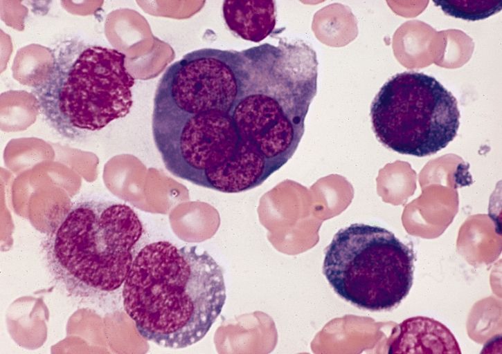 File:AML-M6, multinucleated erythroblast.jpg