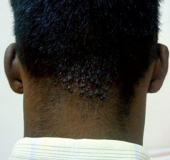 File:Acne keloidalis nuchae.png