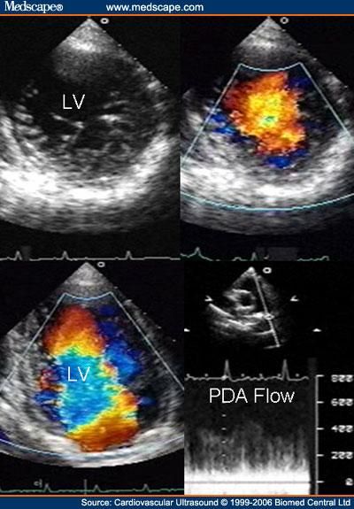 File:Cardiovasc Ultrasound LVNC 2.jpg