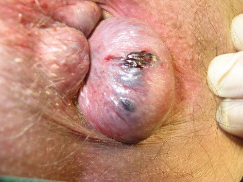 File:Perianal thrombosis 01.jpg