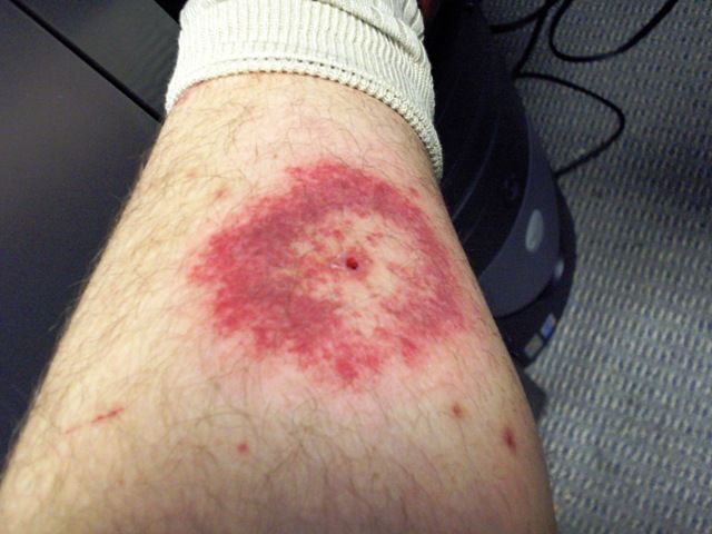 File:STARI Rash.jpg