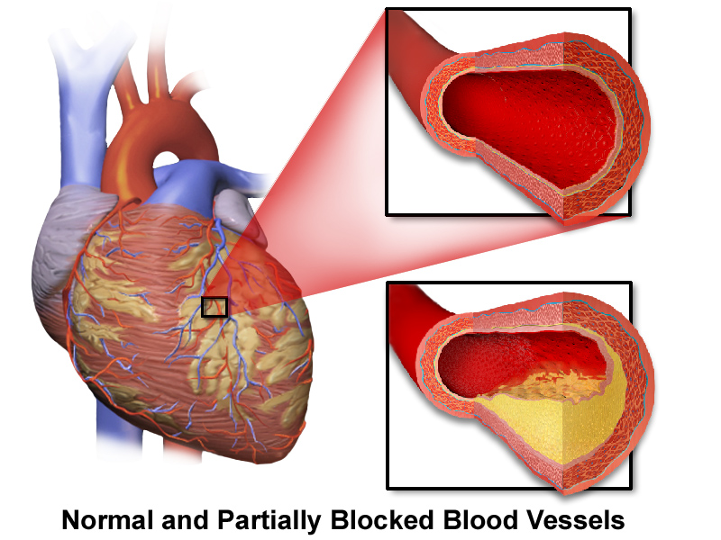 File:Coronary Artery Disease.png