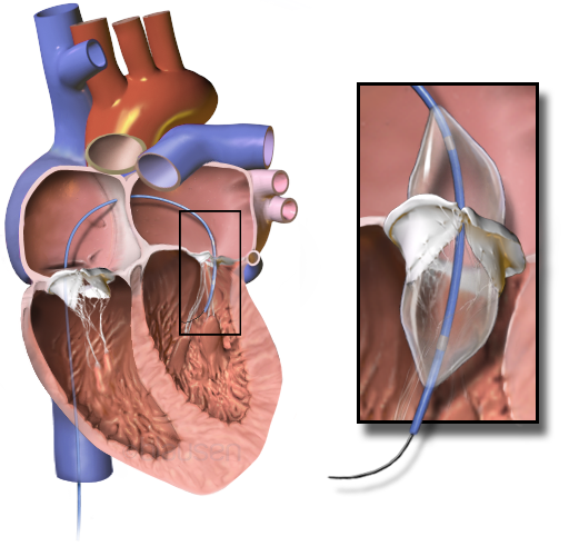 File:Blausen 0889 MitralValvuloplasty.png