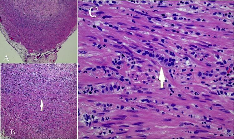 File:Histopathology of appendiceal carcinoid.jpg