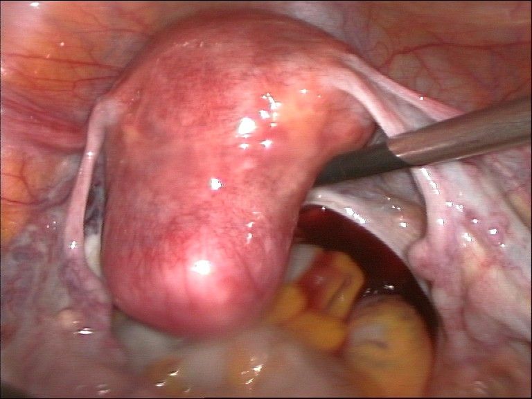 File:Hysterectomy1.jpg