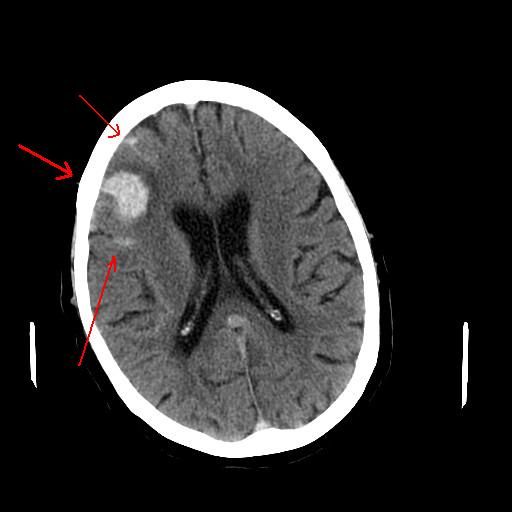 File:Intracerebral.jpg