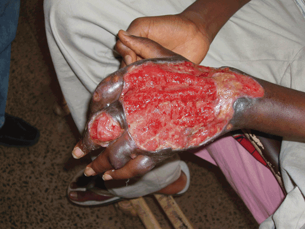 File:Buruli ulcer hand Nigeria.png