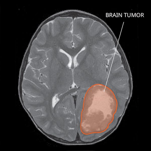 File:MRI of PNET.jpg