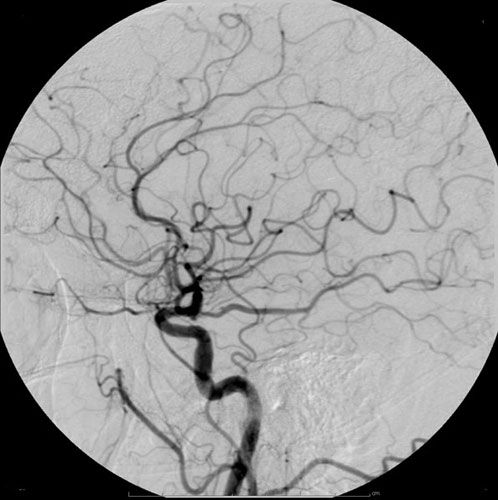 File:Cerebral Angiogram Lateral.jpg