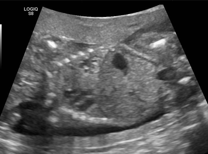 File:Congenital pulmonary airway malformation sagittal.jpg