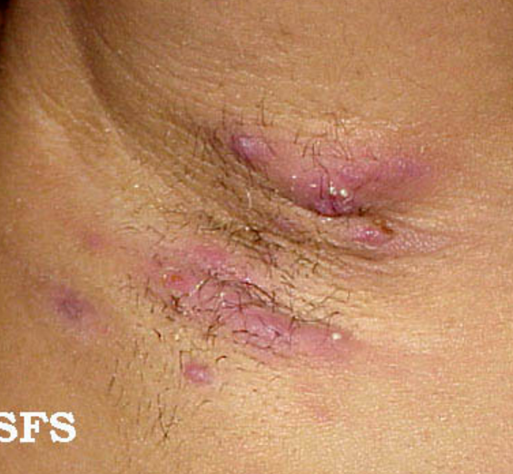 File:Hidradenitis.png