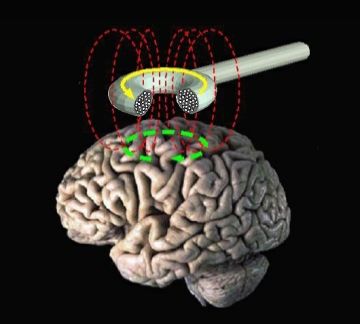 File:Transcranial magnetic stimulation.jpg