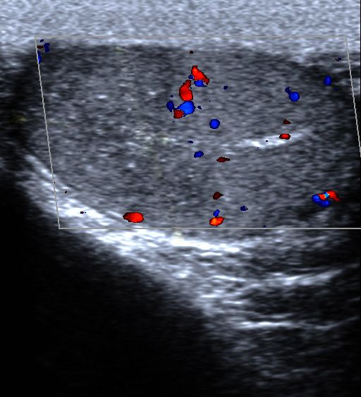 File:Segmental testicular infarction 112914968.jpg