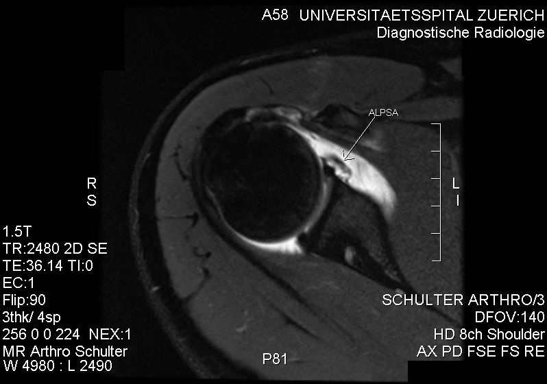 File:MRI. ALPSA lesion.jpg