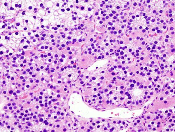 File:Parathyroid adenoma histopathology (3).jpg