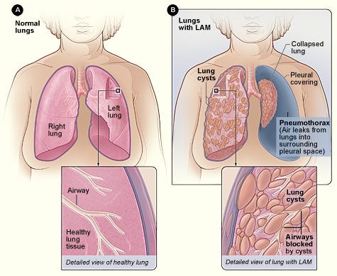 File:Lymphangioleiomyomatosis.jpg