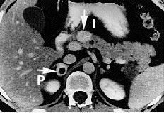 File:Pheochromocytoma.jpg