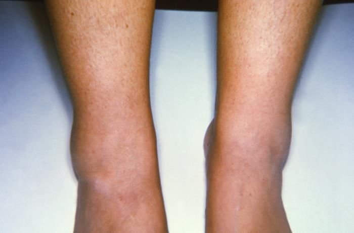 File:Swelling of the ankle joints.jpg