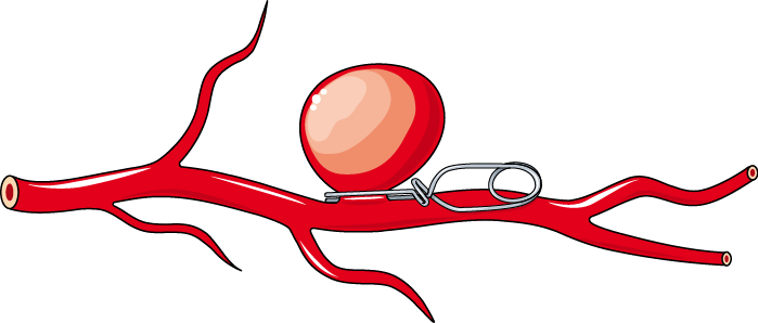 File:Cardiovascular system - Aneurysm clip -- Smart-Servier.png