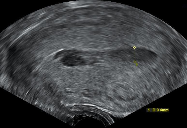 File:Hematometra - postpartum.jpg