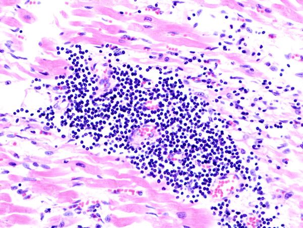 File:Viral myocarditis (1).JPG