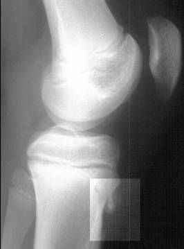 File:Osgood-Schlatter disease X-ray.JPEG