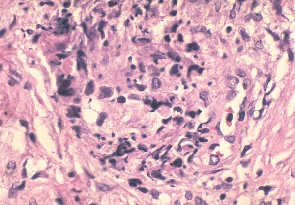 File:Sperm granuloma - Epididymis.jpg