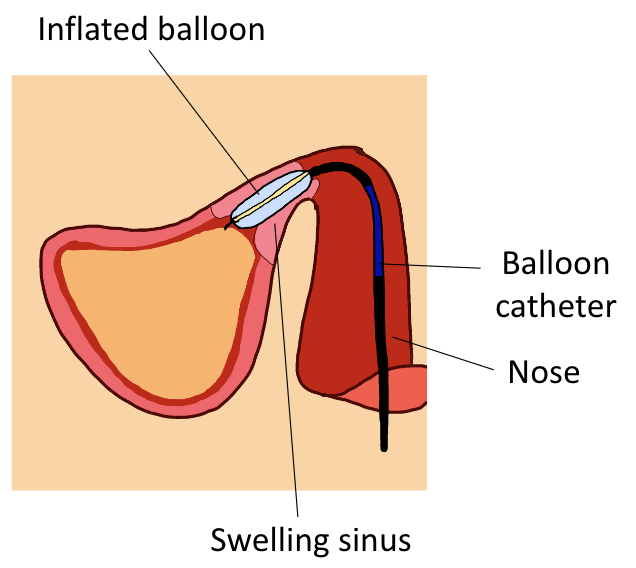 File:Balloon sinuplasty 3.png