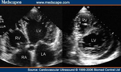 File:Cardiovasc Ultrasound LVNC 3.jpg