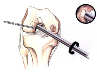 File:Paste Graft Surgery-2.jpg