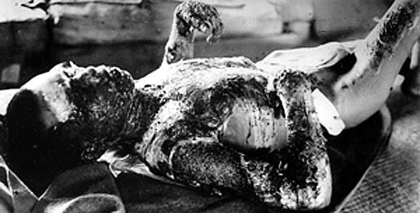 File:Victim of Atomic Bomb 001.jpg