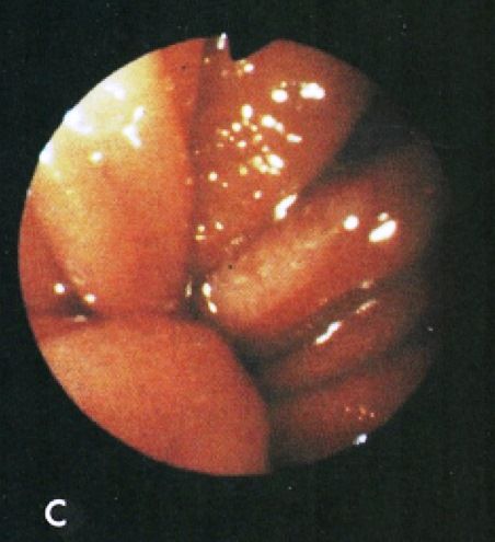 File:Cameron lesions wiki (photos only)-2C.jpg