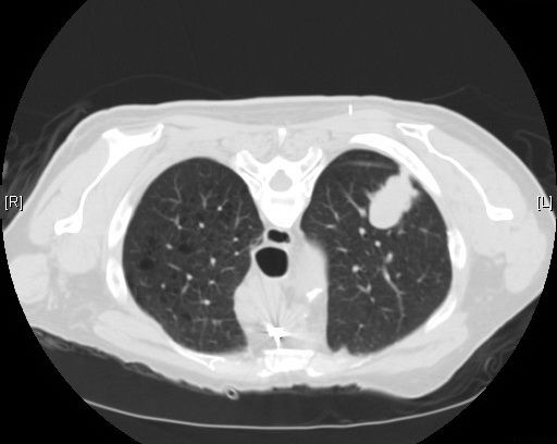 File:Adenocarcinoma - CT scan (5499628365).jpg