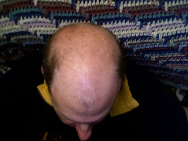 File:Bald head.jpg