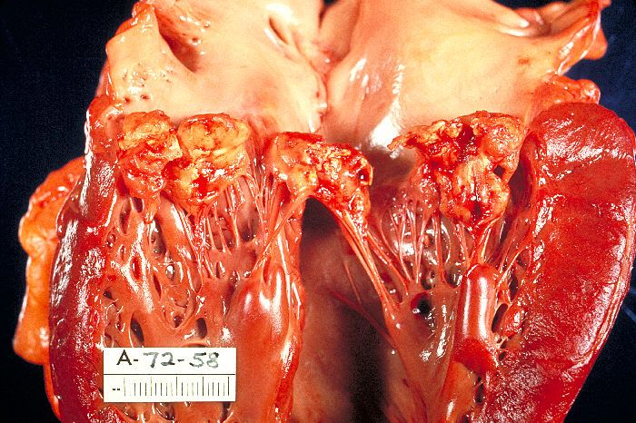 File:Haemophilus parainfluenzae Endocarditis PHIL 851 lores.jpg