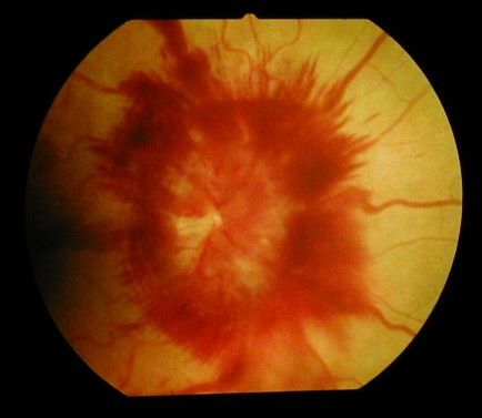 File:Optic disc edema and haemorrhage.jpg