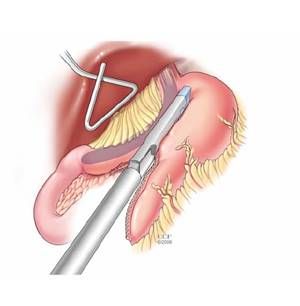 File:Realización de gastrectomía.jpg