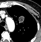 File:CT of a fat containing hamartoma.png