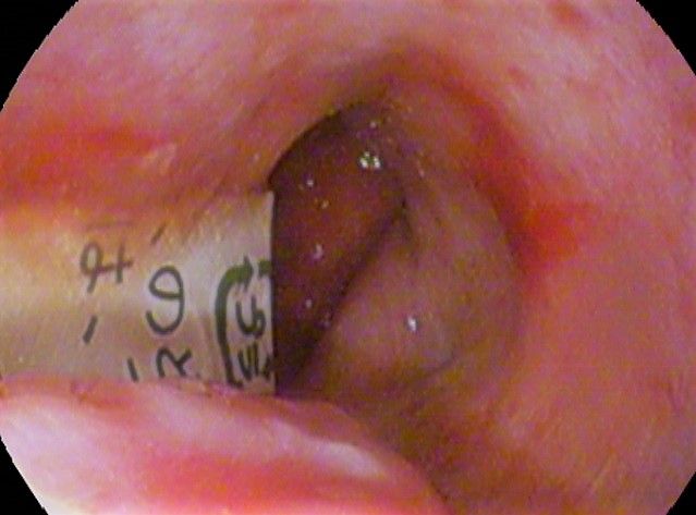 File:Foreign body in esophagus.jpg