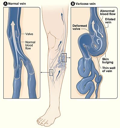 File:Varicose veins.jpg