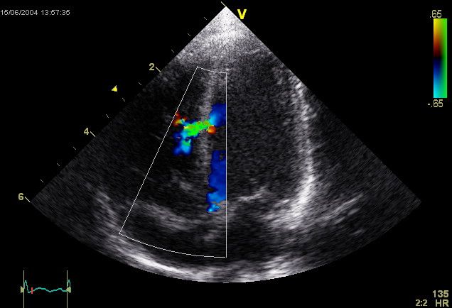 File:Ventricular Septal Defect.jpg