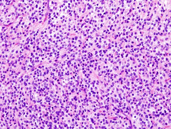 File:Anaplastic oligodendroglioma (1).jpg