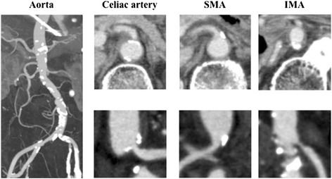 File:Arterial atherosclerosis.jpg