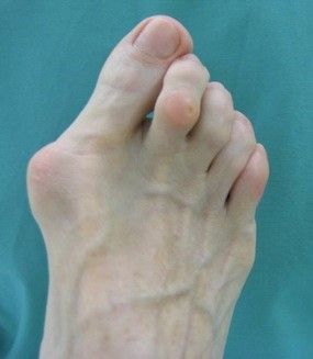 File:Hallux valgus und Krallenzehe II (präop.).jpg