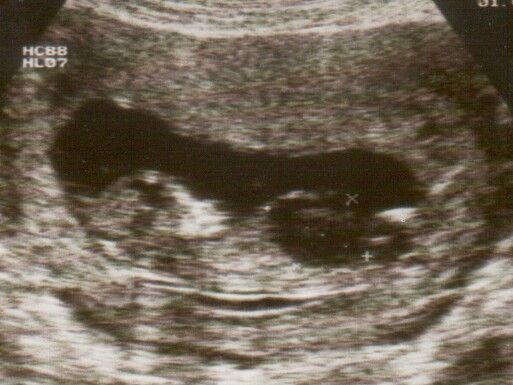 File:Ultrasound Scan ND 104.jpg