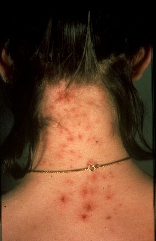 File:Fig.4.Louse bites.jpg