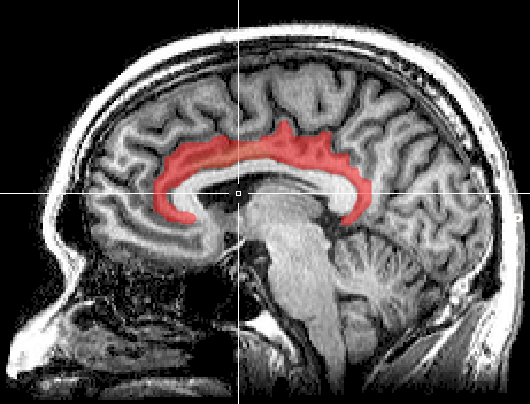 File:MRI cingulate cortex.png