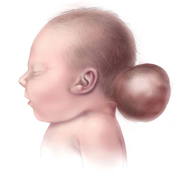 File:Encephalocele-web.jpg