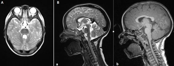 File:Syndrome de Joubert IRM PAMJ-22-127-g001.jpg